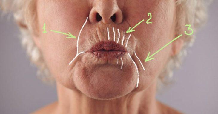 Как убрать глубокие морщины вокруг рта
