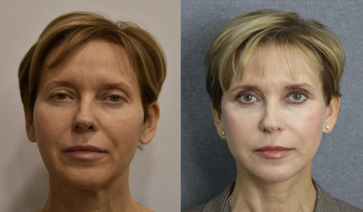 Фейслифтинг лица фото до и после