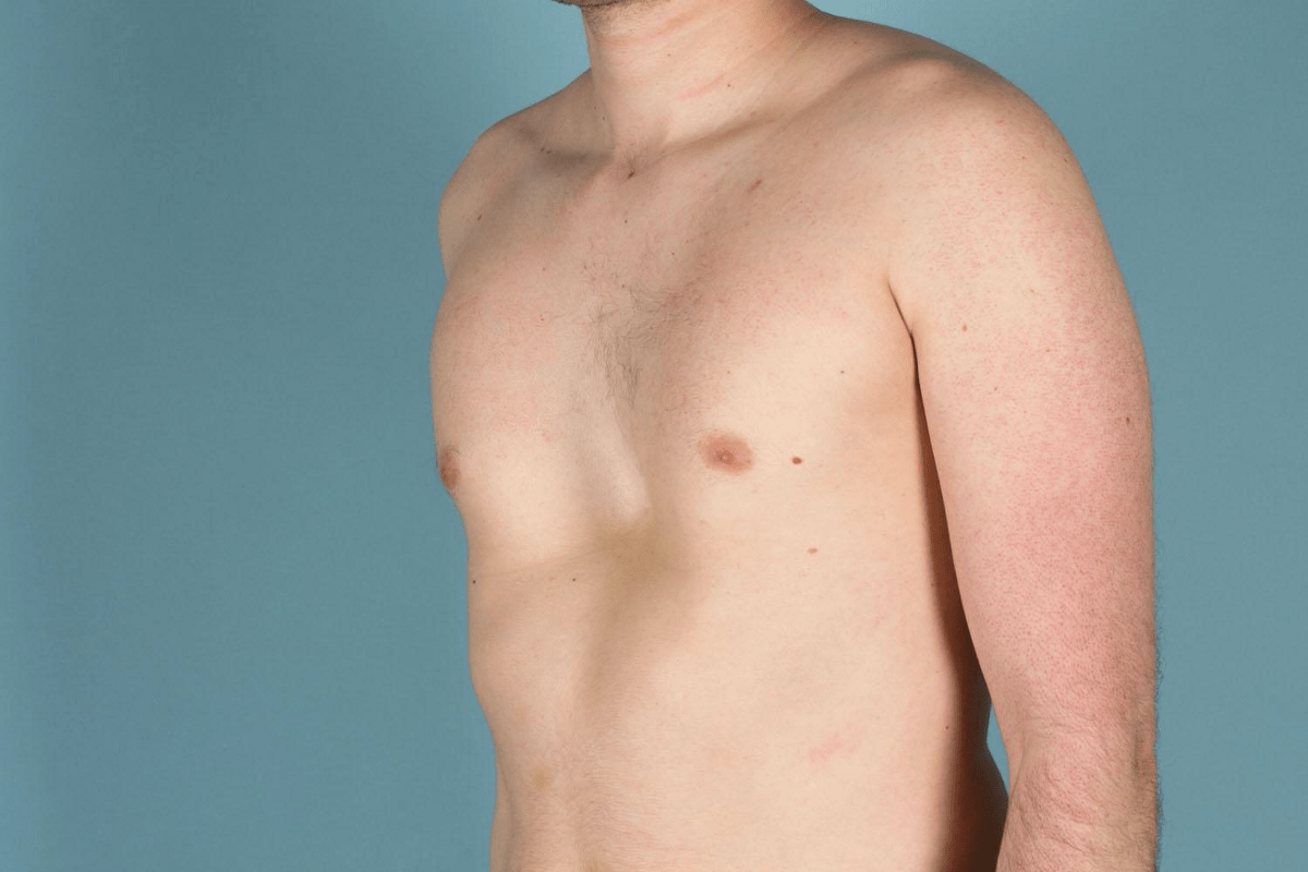 выпирающая грудь у мужчин фото 83