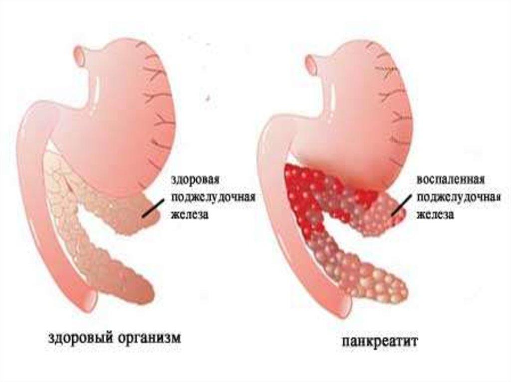 Панкреатит и язва желудка. Панкреатит поджелудочной железы. Здоровая поджелудочная железа. Воспаление поджеудочнойжелезы. Поджелудочная железа здоровая и воспаленная.