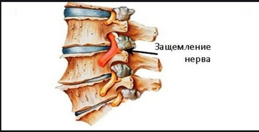 Как лечить защемление шейного отдела