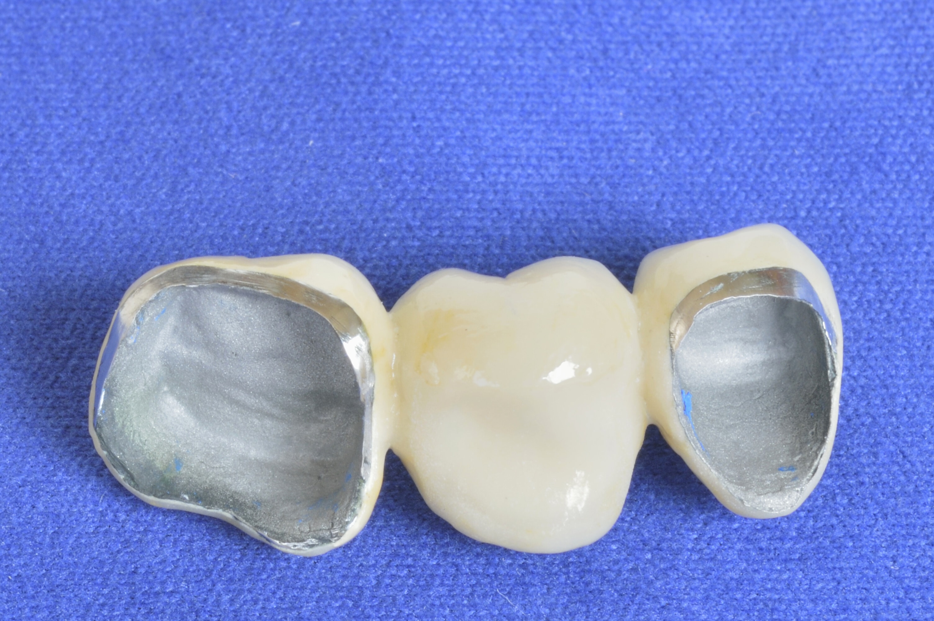 Как выглядят зубы из металлокерамики фото
