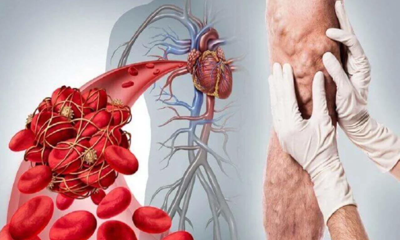 Тромбоз артерия и вена. Тромбоз кровеносных сосудов. Тромбоэмболия кровеносного сосуда. Тромб в кровеносном сосуде.