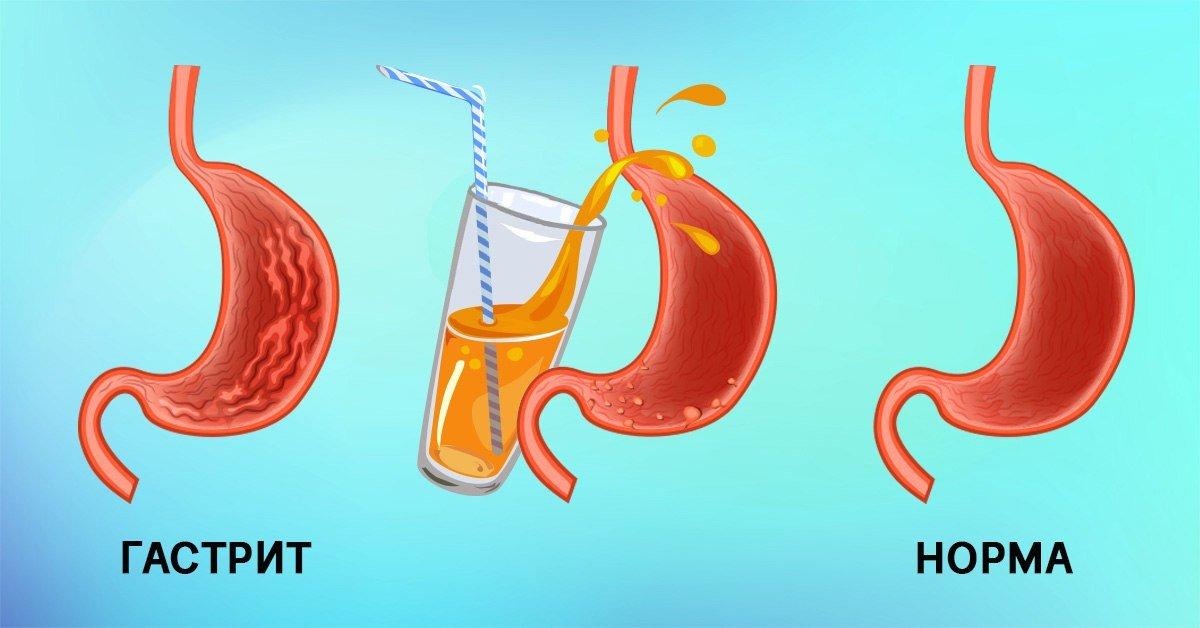 Сок при панкреатите. Сок при язве желудка. Соки при гастрите. Желудочный сок при гастрите.